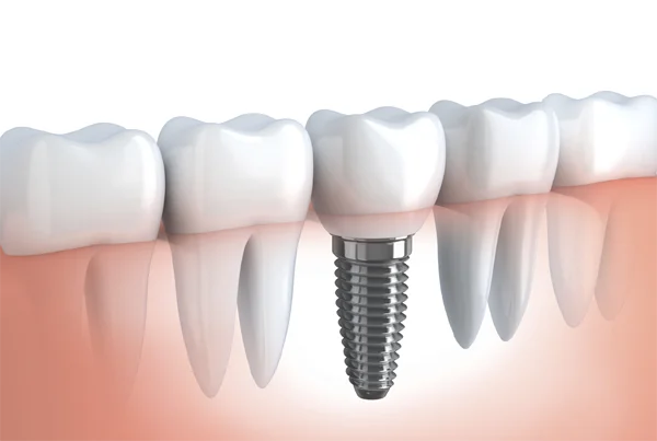 Implants